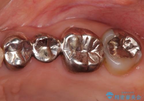 臼歯 咬合の再構成の治療前