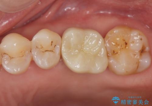 奥歯の欠損 インプラントによる咬合機能回復の治療後