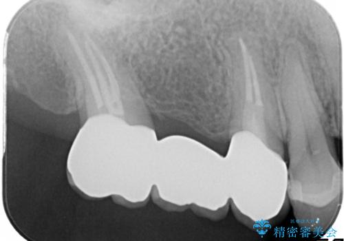 奥歯のオールセラミックブリッジの治療後