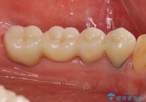 老朽化したブリッジのやりかえの治療後