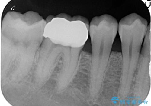 以前治療歯の中が虫歯になっている気がする　セラミッククラウンによる再補綴の治療後