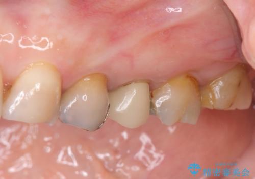 放置してしまった深い虫歯の治療の症例 治療前