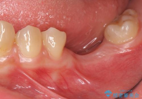 臼歯の噛み合わせをインプラントを用いて回復するの治療前