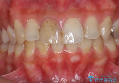 前歯 審美改善セラミック治療の治療前
