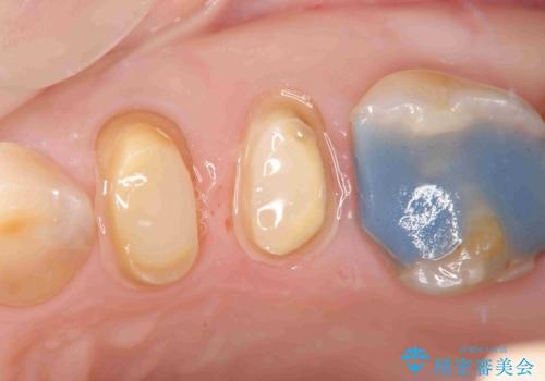 放置してしまった深い虫歯の治療の治療前