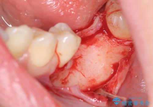 臼歯の噛み合わせをインプラントを用いて回復するの治療中