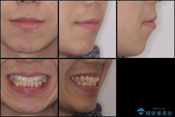 インビザラインで整った口元にの治療前(顔貌)