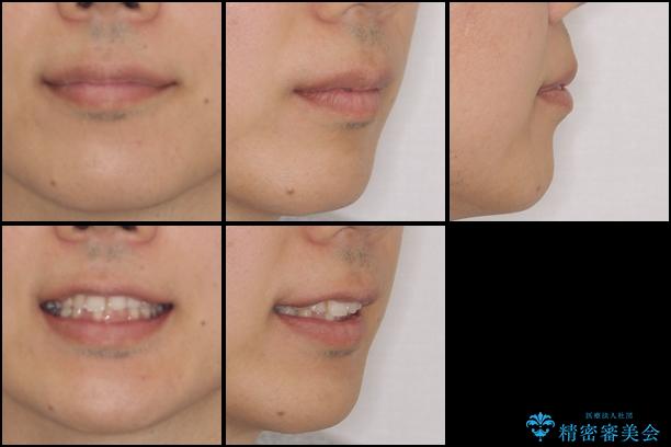 インビザライン矯正とインプラント補綴　深い咬み合わせと奥歯の欠損治療の治療前（顔貌）