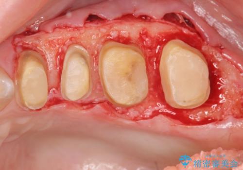 放置してしまった深い虫歯の治療