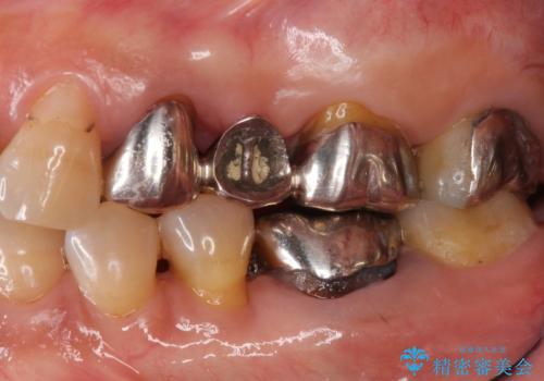 臼歯　咬合の再構成の症例 治療前