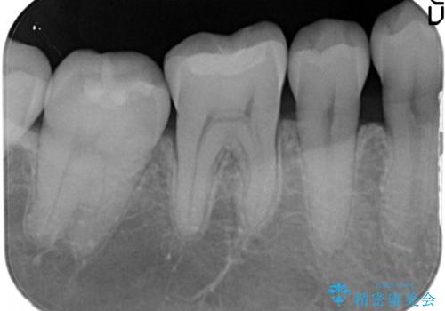 治療したむし歯の再治療。セラミックにしたい!の治療後
