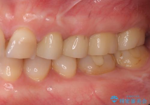 放置してしまった深い虫歯の治療の治療後