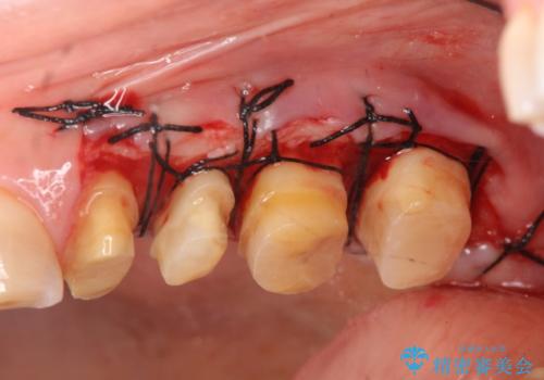 放置してしまった深い虫歯の治療の治療中