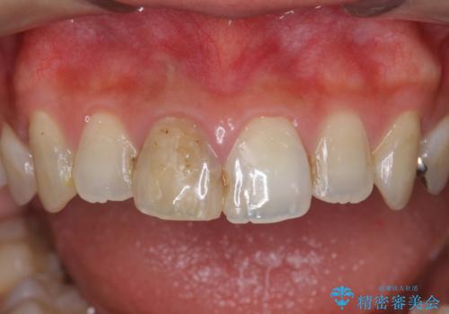 前歯　審美改善セラミック治療の治療前