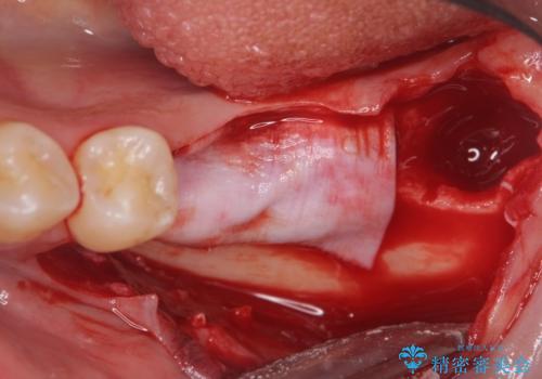 臼歯の噛み合わせをインプラントを用いて回復するの治療中
