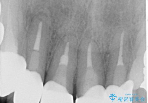 上の前歯の根元が黒い 根の治療を含めたセラミック再治療の治療後