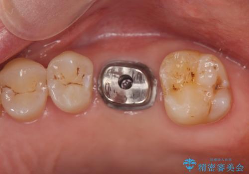 奥歯の欠損 インプラントによる咬合機能回復の治療中