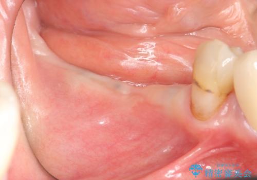 [遊離歯肉移植]  インプラント周囲の角化歯肉の獲得の症例 治療前
