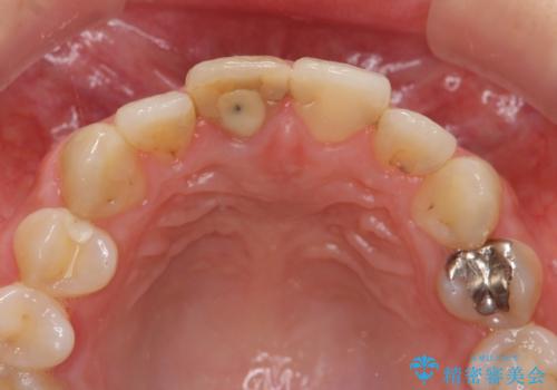 前歯 審美改善セラミック治療の治療前