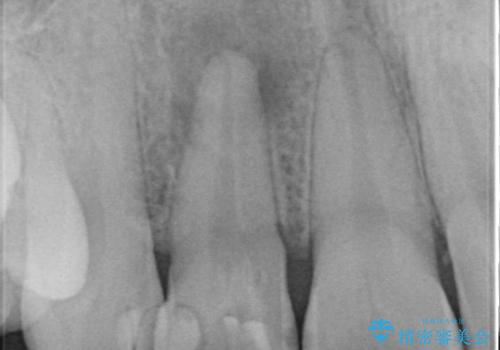 前歯が痛い。根管治療~セラミッククラウンの治療前