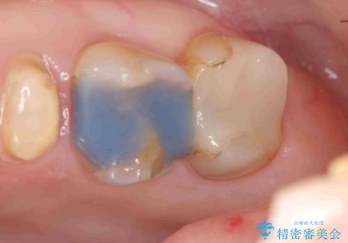 放置してしまった深い虫歯の治療の治療前