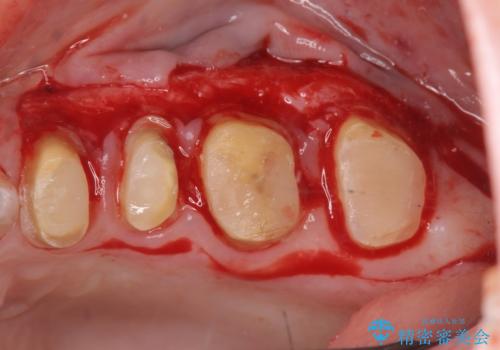 放置してしまった深い虫歯の治療の治療中