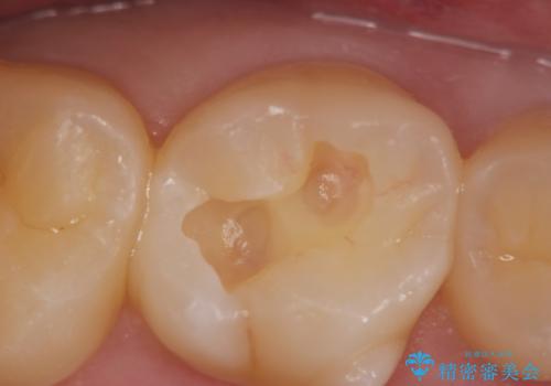 検診による初期虫歯の早期発見・早期治療の治療中