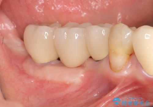 [遊離歯肉移植]  インプラント周囲の角化歯肉の獲得の症例 治療後