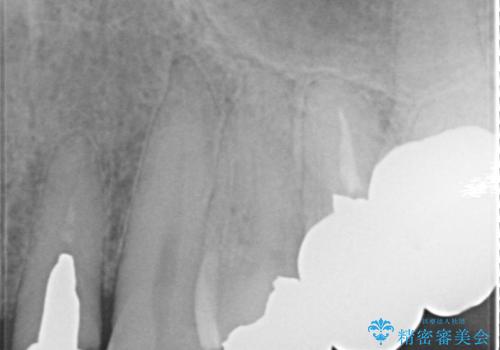 上の前歯の根元が黒い 根の治療を含めたセラミック再治療の治療前