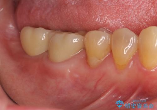 奥歯　インプラントによる機能回復の治療後