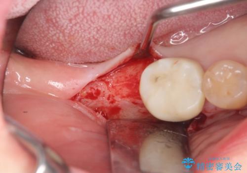 奥歯　インプラントによる機能回復の治療中