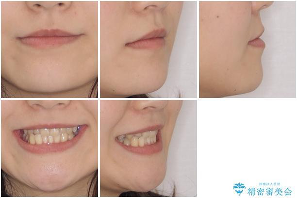 奥歯の反対咬合 上顎骨を拡大してインビザラインで矯正の治療前(顔貌)