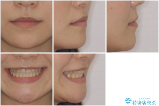 奥歯の反対咬合 上顎骨を拡大してインビザラインで矯正の治療後(顔貌)