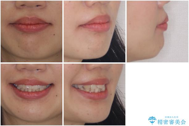 インビザラインで機能面に問題のある歯列を改善の治療前(顔貌)