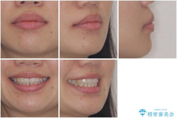 インビザラインで機能面に問題のある歯列を改善の治療後(顔貌)