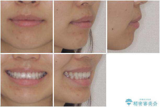 インビザラインによる軽度な出っ歯の矯正治療の治療後(顔貌)