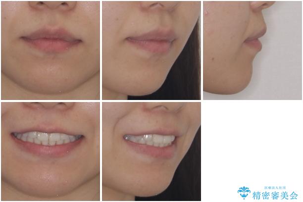 インビザライン矯正とインプラント治療と 総合歯科治療の治療後(顔貌)