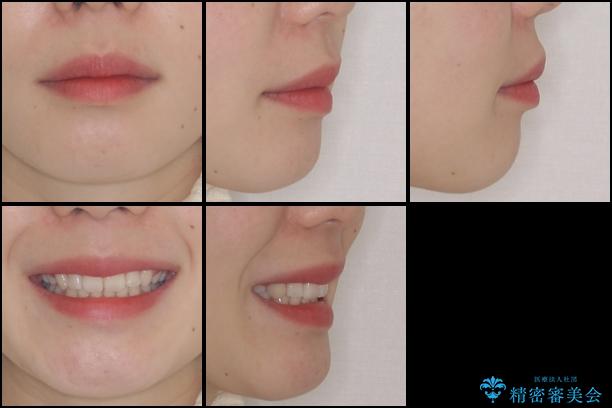 目立たない裏側矯正 抜歯矯正で口元を改善の治療後(顔貌)