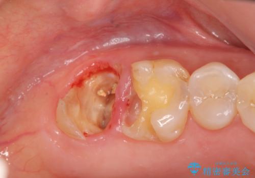 歯髄方向 歯肉方向へと深い 2種類の大きな虫歯の治療後