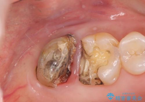 歯髄方向 歯肉方向へと深い 2種類の大きな虫歯の治療前