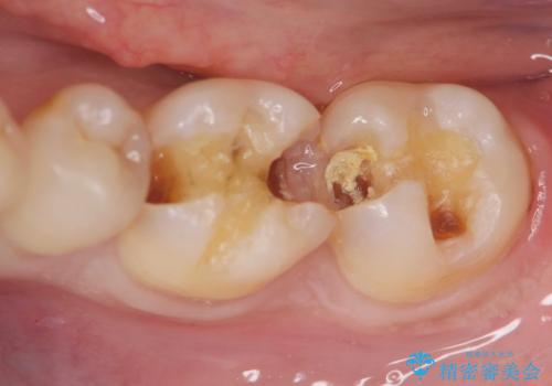 保険適応の白い詰め物レジンインレー下に再発した大きな虫歯治療の治療中