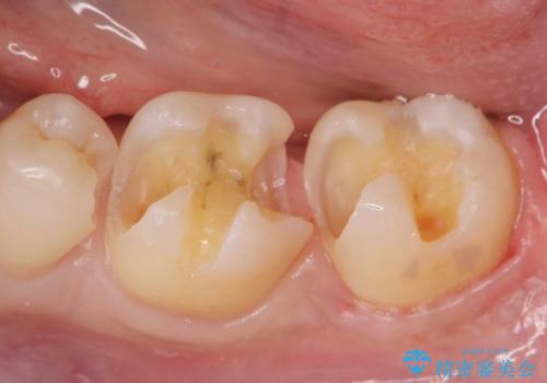保険適応の白い詰め物レジンインレー下に再発した大きな虫歯治療の治療中