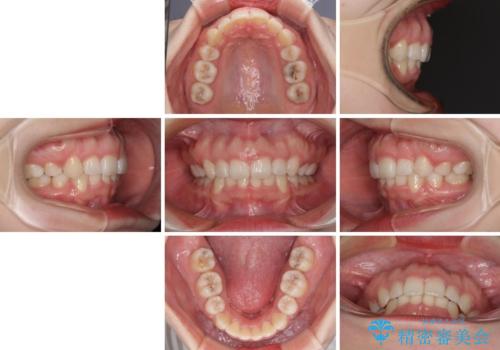 目立たない裏側矯正 抜歯矯正で口元を改善の治療後