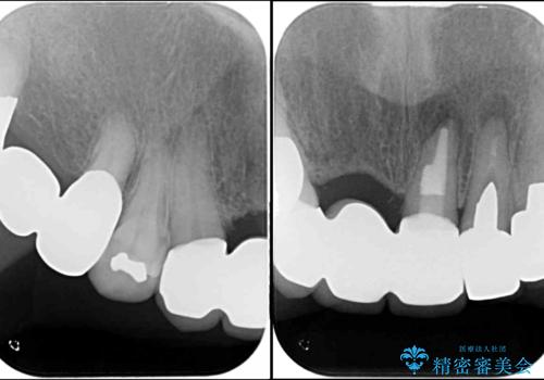 着色が著しい前歯のブリッジをオールセラミックできれいにの治療後