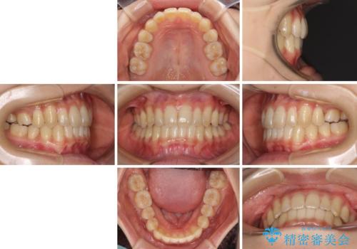 奥歯の反対咬合 上顎骨を拡大してインビザラインで矯正の治療後