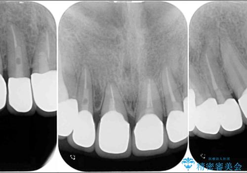 深い虫歯と不自然な色調の前歯 オールセラミッククラウンで自然にの治療後