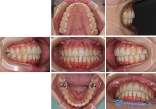 インビザラインで機能面に問題のある歯列を改善の治療後