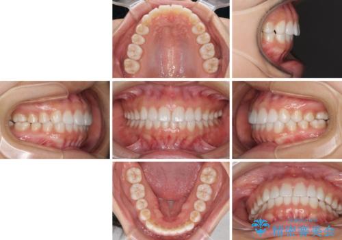 インビザラインによる軽度な出っ歯の矯正治療の治療後