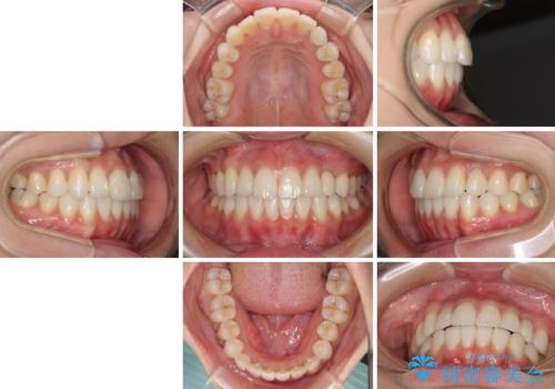 インビザライン矯正とインプラント治療と 総合歯科治療の治療後