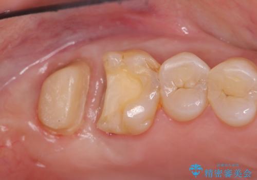 歯髄方向 歯肉方向へと深い 2種類の大きな虫歯の治療中